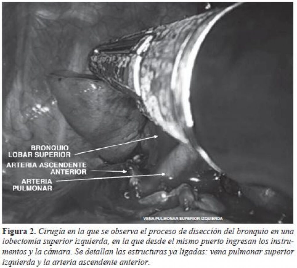 Lobectomía Pulmonar