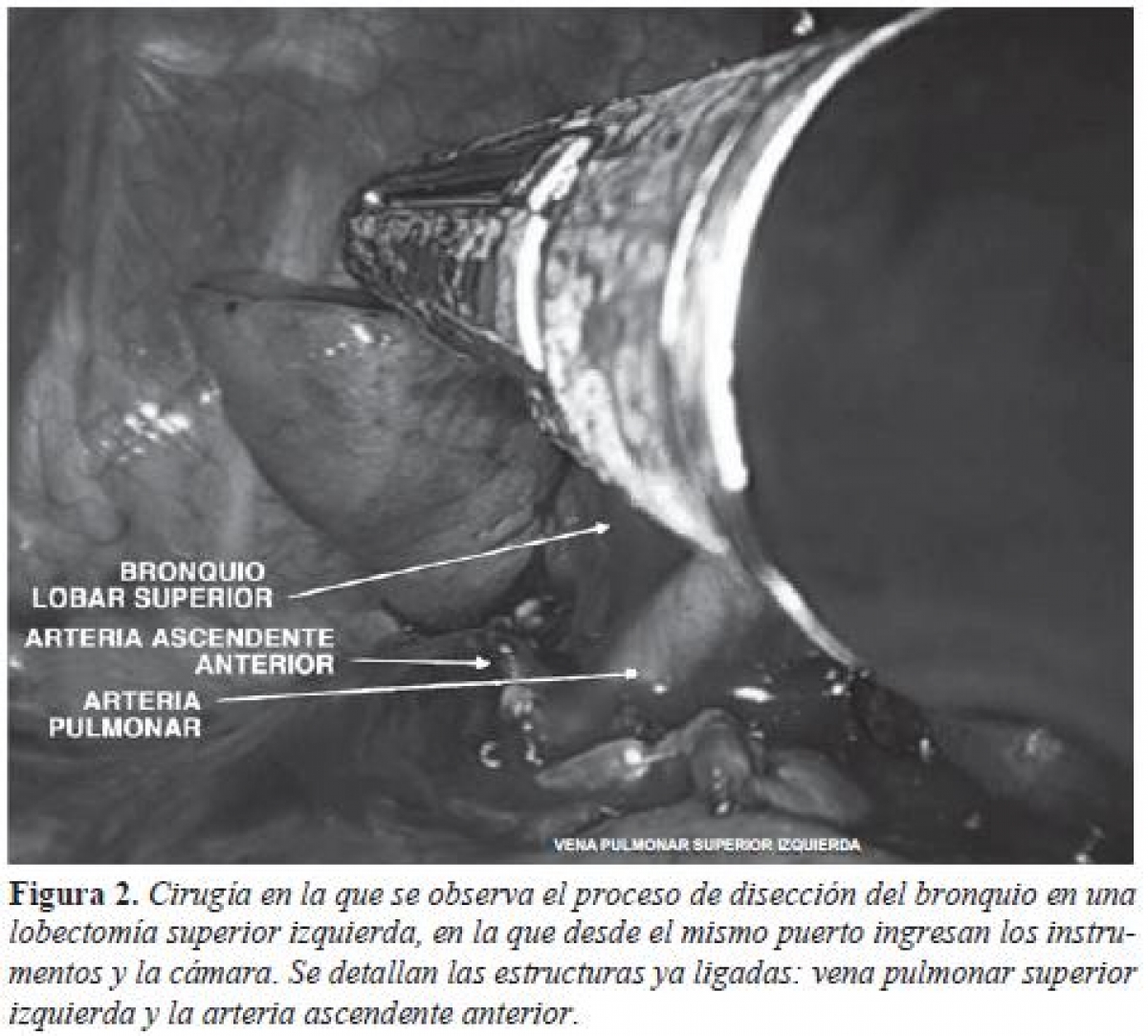 Lobectomía Pulmonar