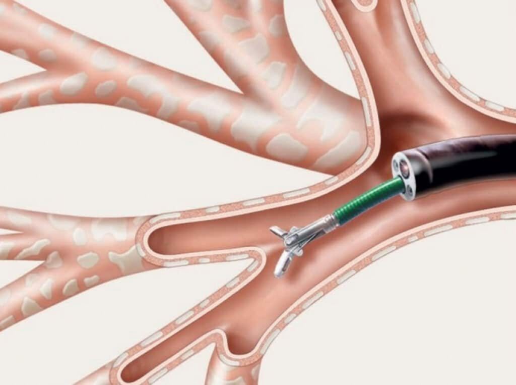 biopsia pulmonar