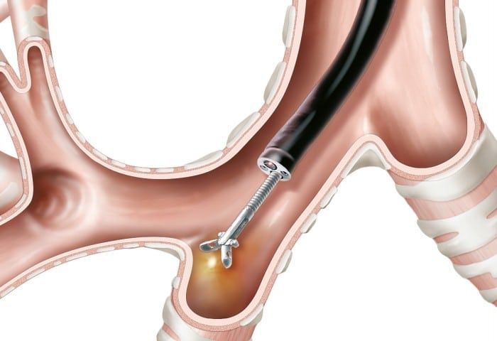biopsia de pulmón abierta