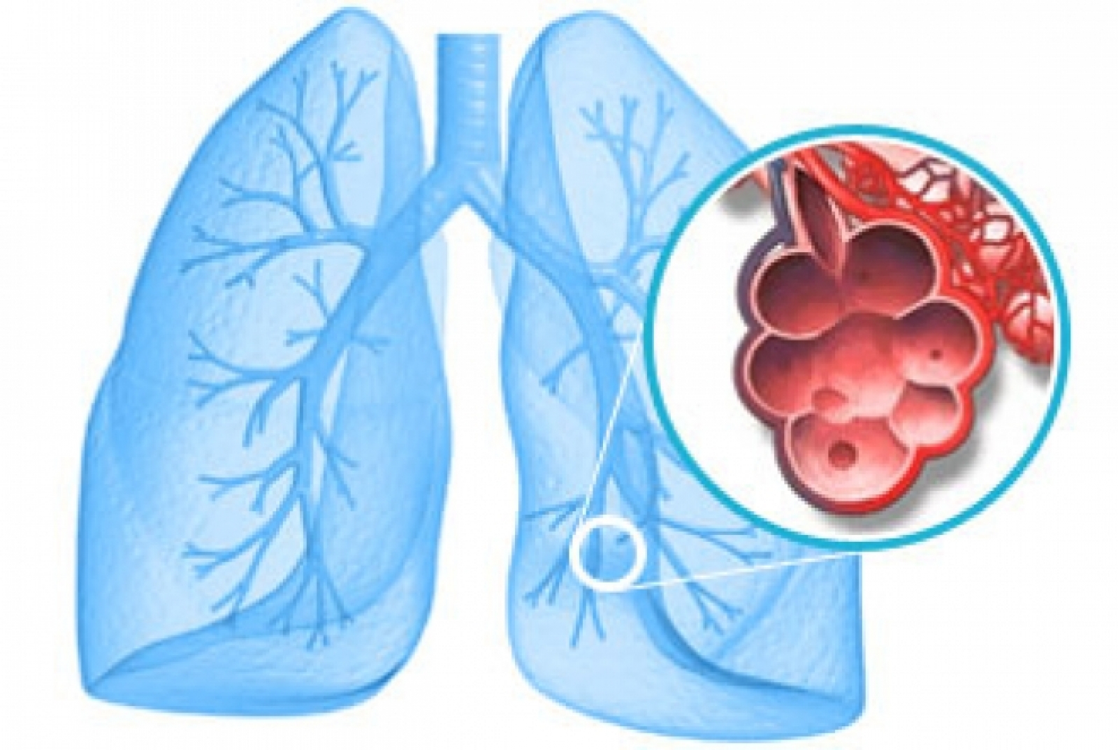 Cáncer de Pulmón