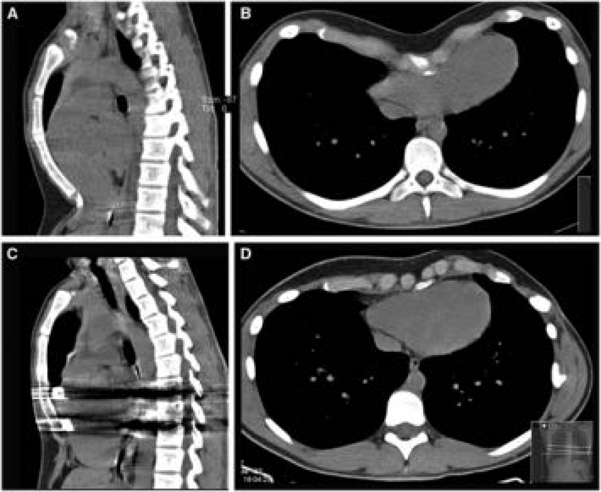 pectus excavatum