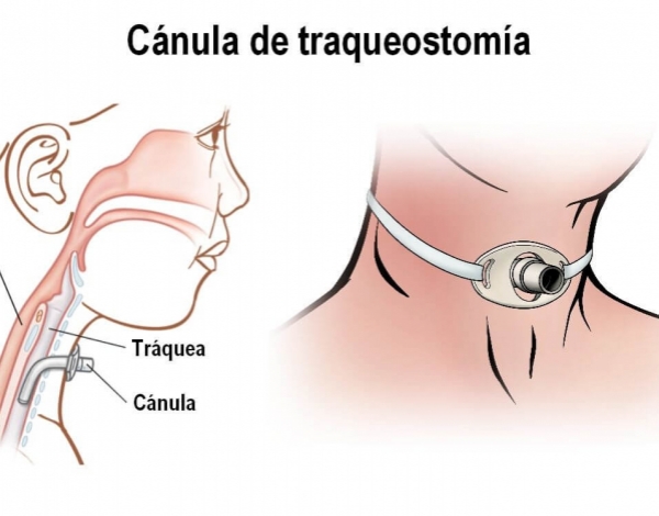 Traqueostomía