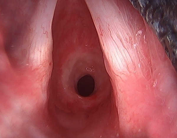 Estenosis